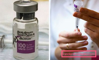 Botox în buze, la modă sau prost