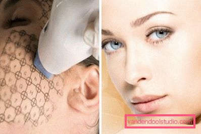 termage procedure termage procedure